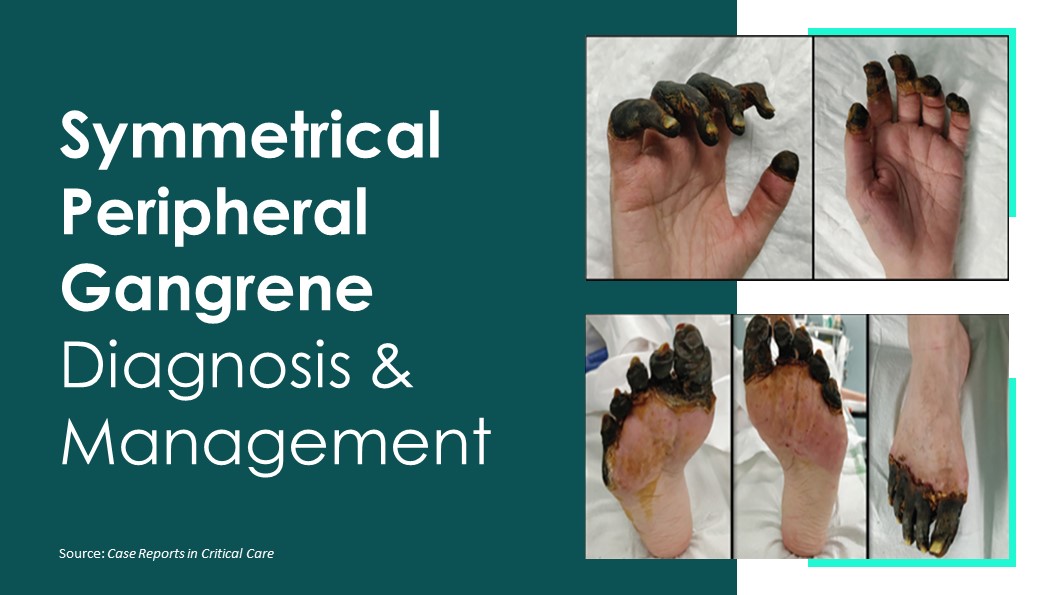 A Rare Case of Symmetrical Peripheral Gangrene