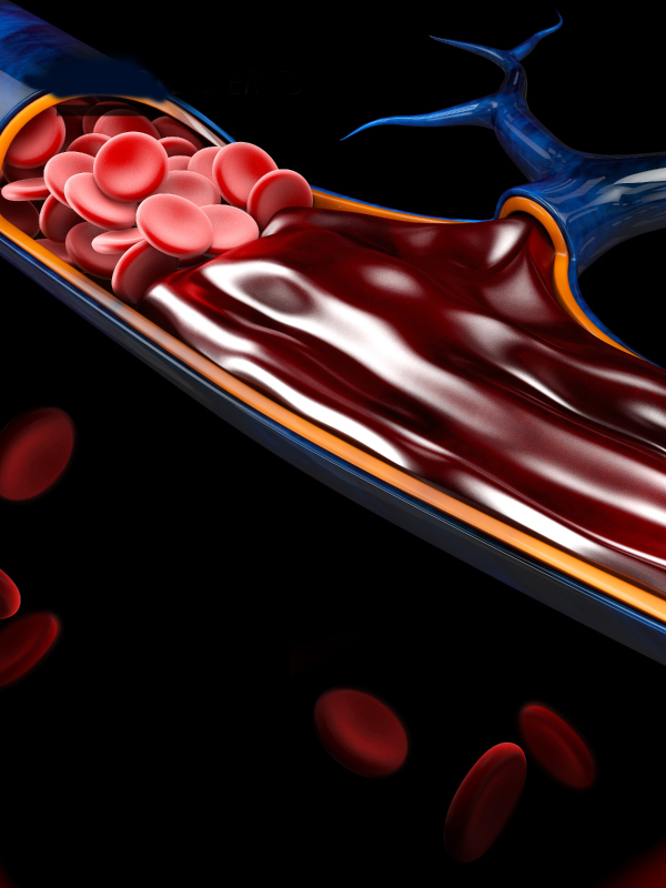 Treatment of Deep Venous Insufficiency with Prosthetic Vein Valve