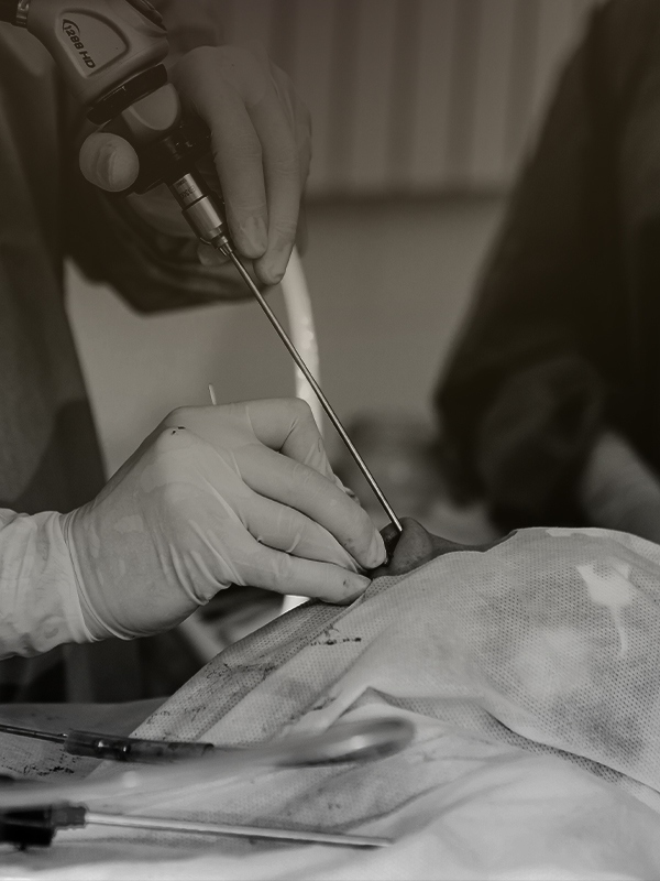 Functional Endoscopic Sinus Surgery