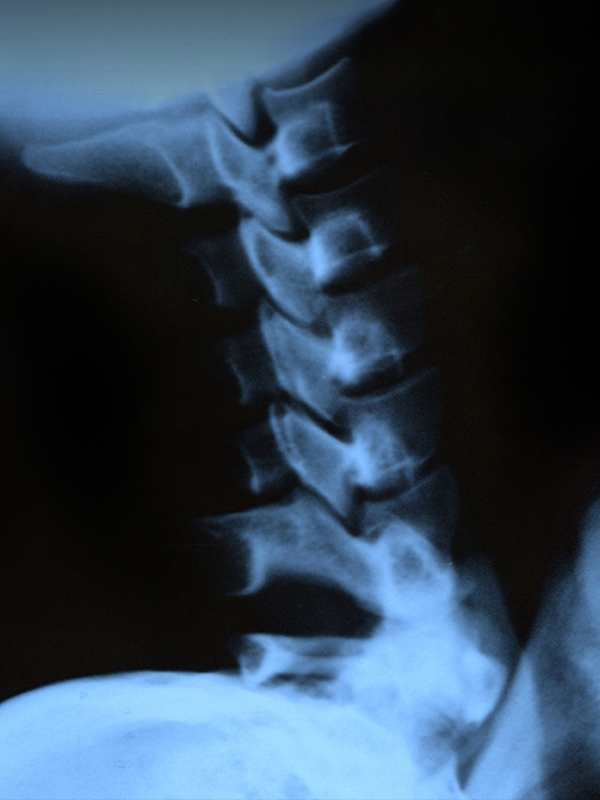 Cervical Disc Replacement