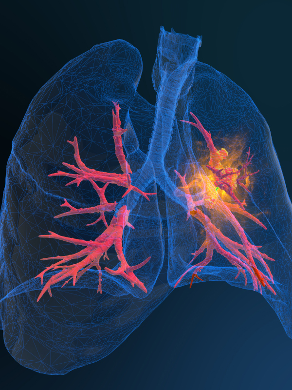 Immunotherapy in Lung Cancer