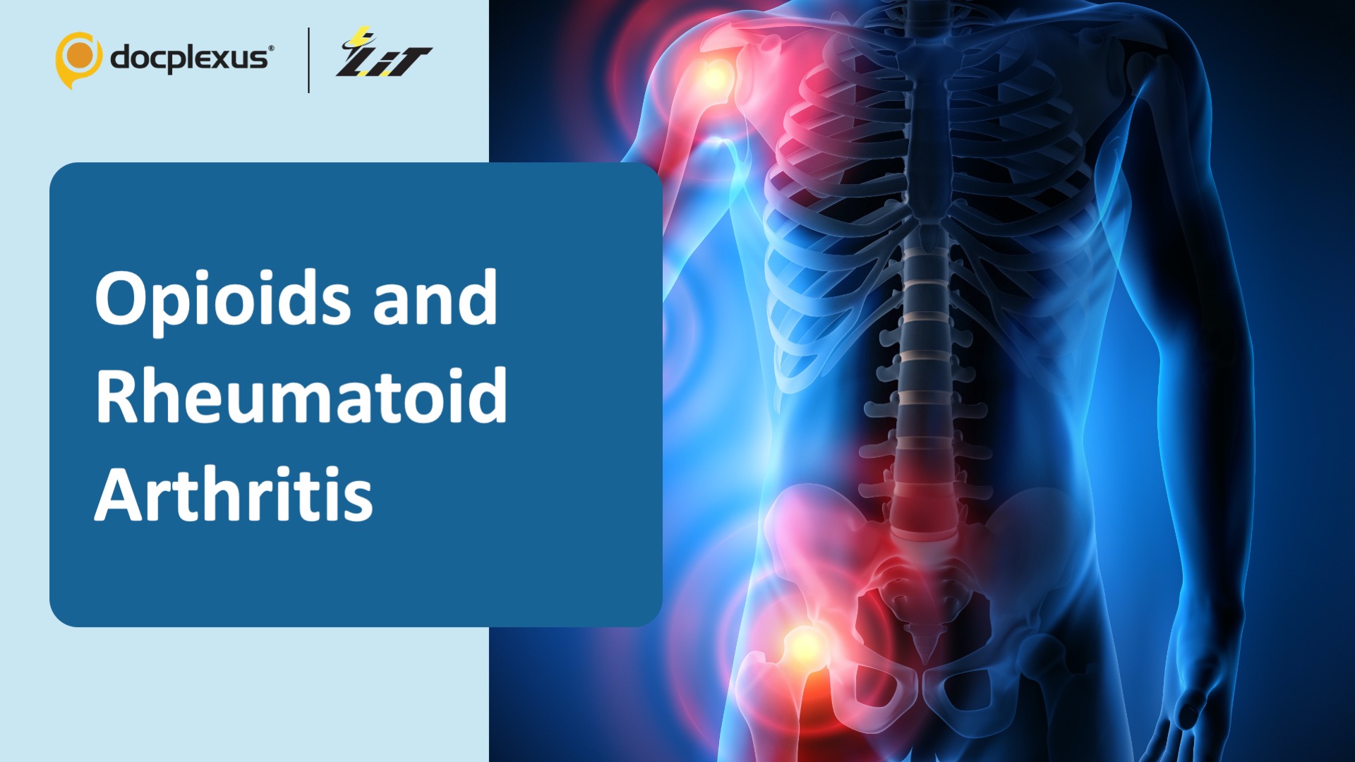 NSAIDs vs Opioids for Rheumatoid Arthritis