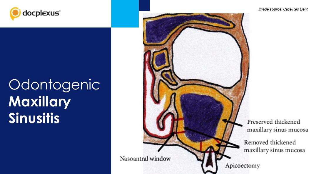 A Novel Way to Manage Odontogenic Maxillary Sinusitis