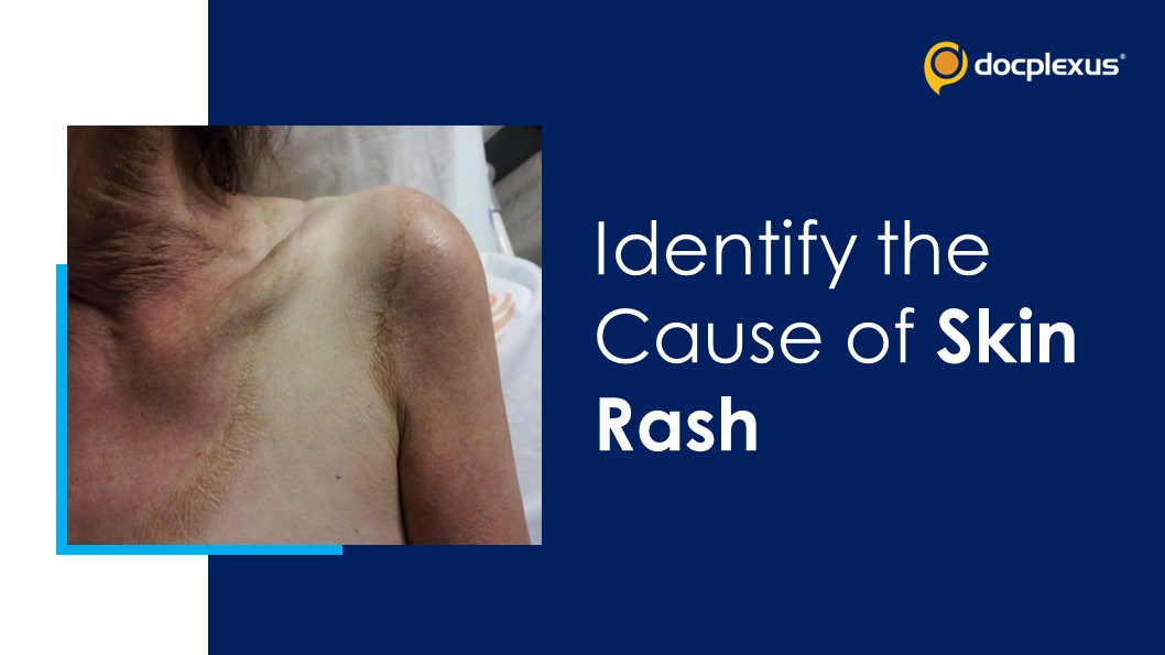 Diarrhea, Ring of Erythema Extending Neck-to-chest, and Disorientation