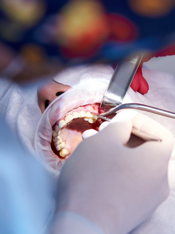 Basics of Dental Implant