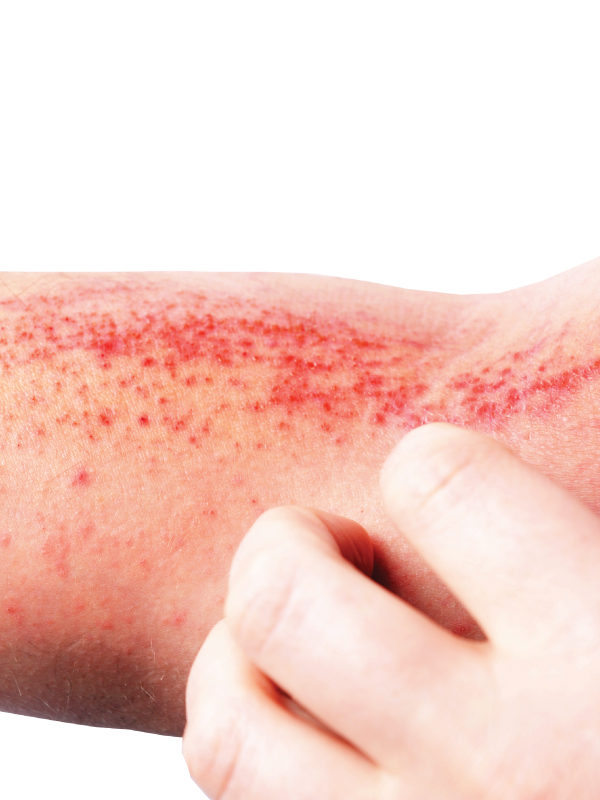 Game Changers in Atopic Dermatitis