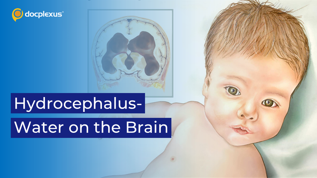 Pediatric Hydrocephalus: An Overview on the Etiology and Treatment
