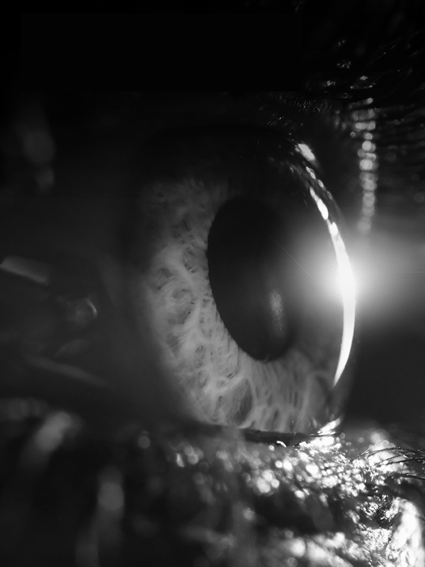 Pearls for Infantile and Pediatrics Cataract Surgery and IOL Implantation