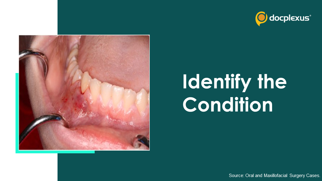 A Rare Case of Lower Jaw Pain and Lip Numbness