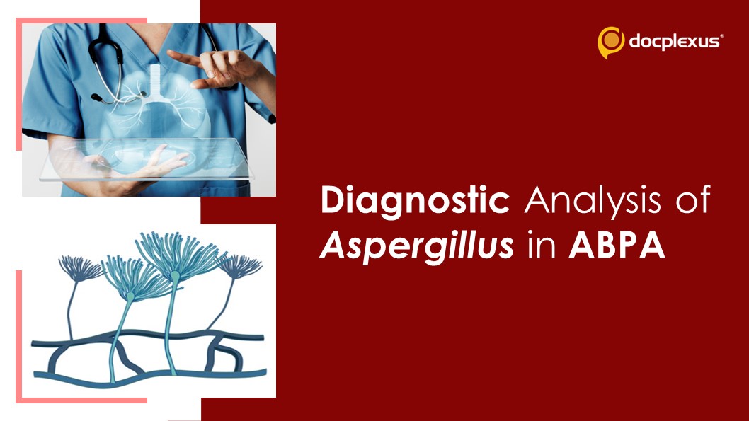ImmunoCapTM for ABPA: A Promising Diagnostic Approach