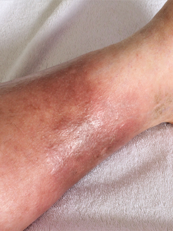 Overlap Syndromes and Management