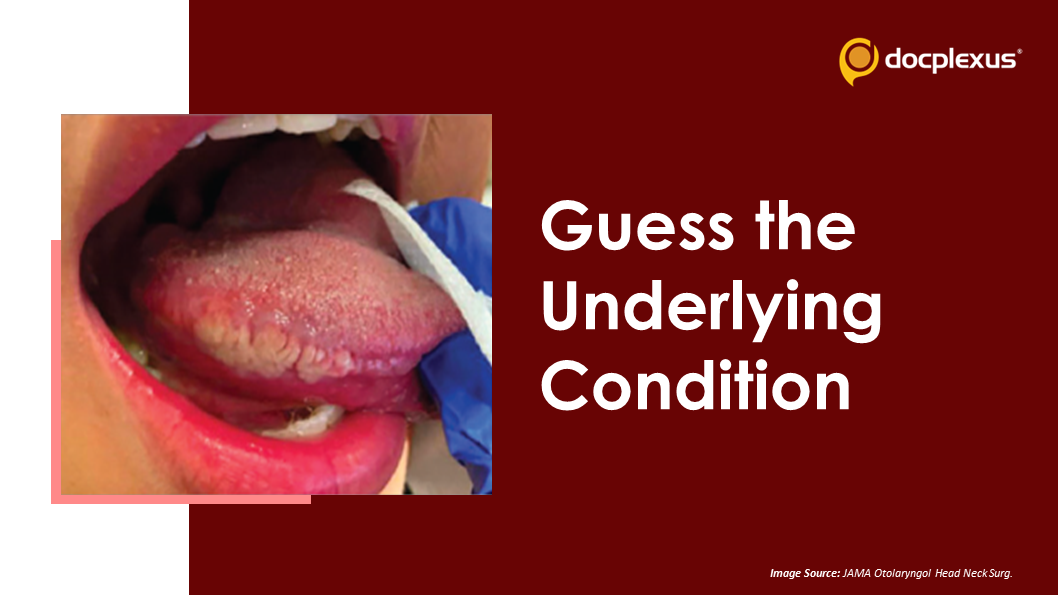 Case of a Young Man with Hairy, Painful Leukoplakia on Tongue