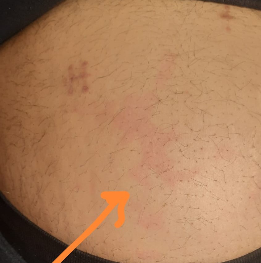 What Can be the Management of this Unusual Skin Condition?