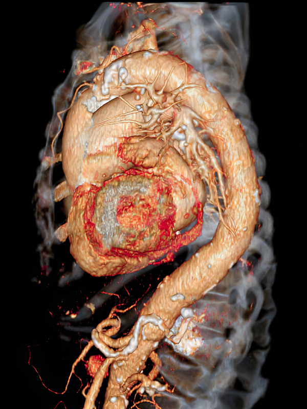 Management of Complex Aortic Pathologies