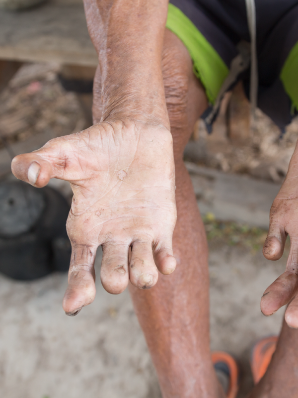 Hansen's Disease – An Overview