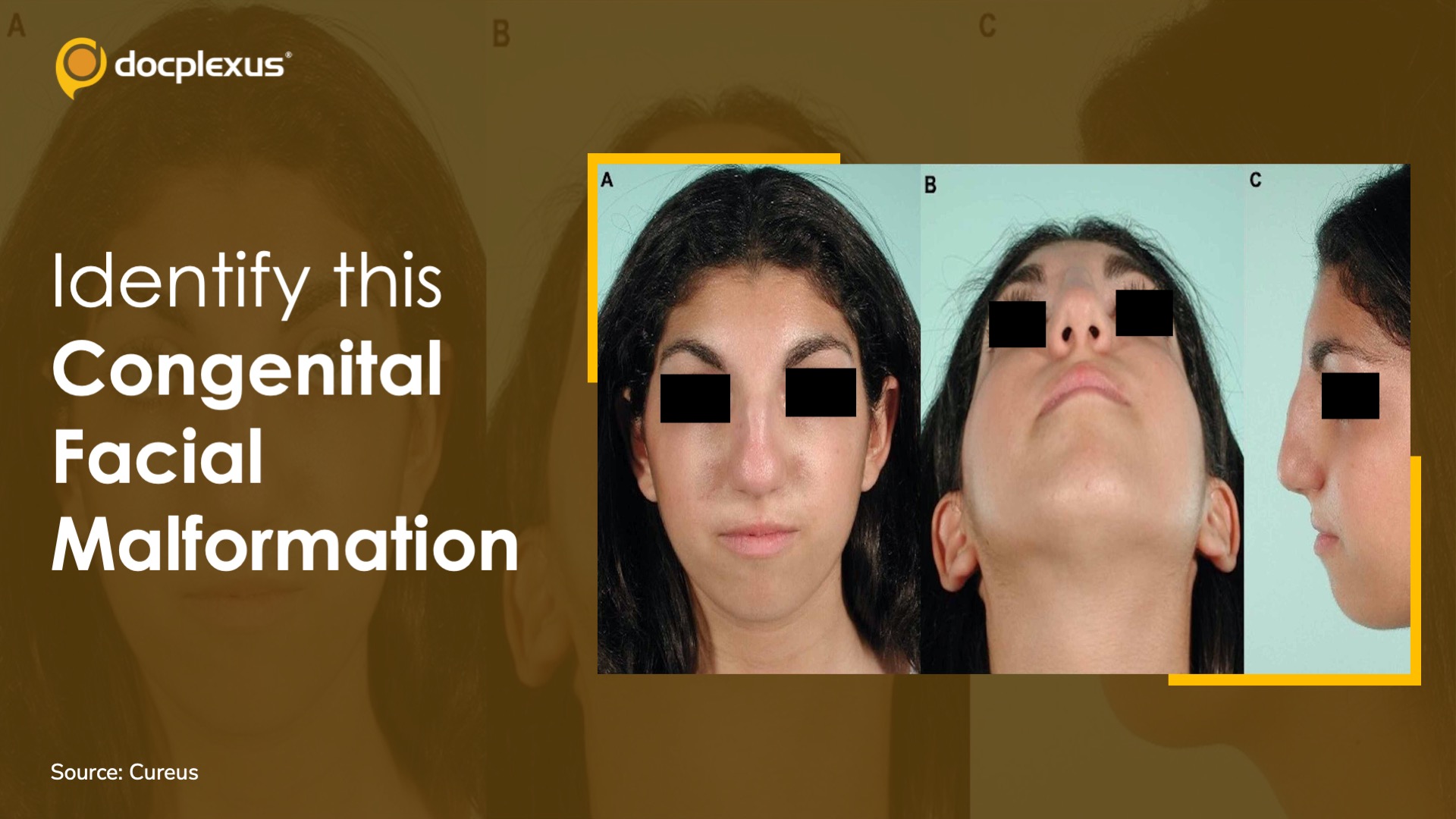 Diagnose this Patient with Congenital Facial Malformation