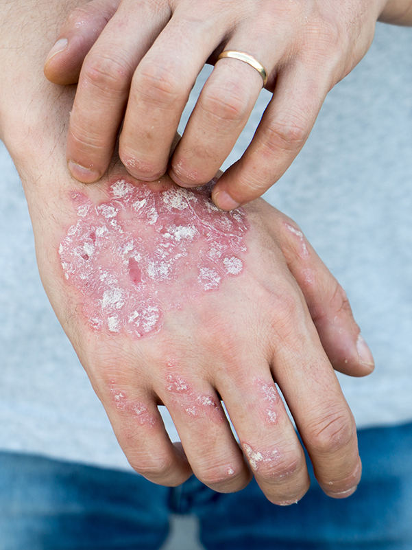 Psoriasis is Not Skin Deep
