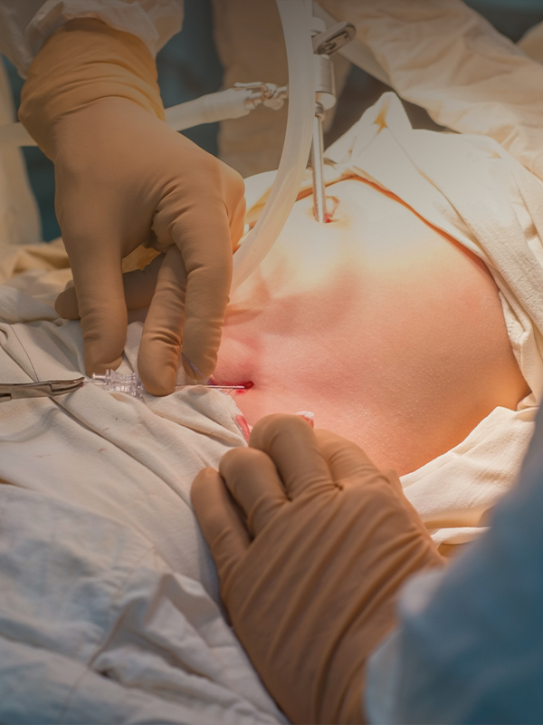Laparoscopic Ventral Hernia Repair