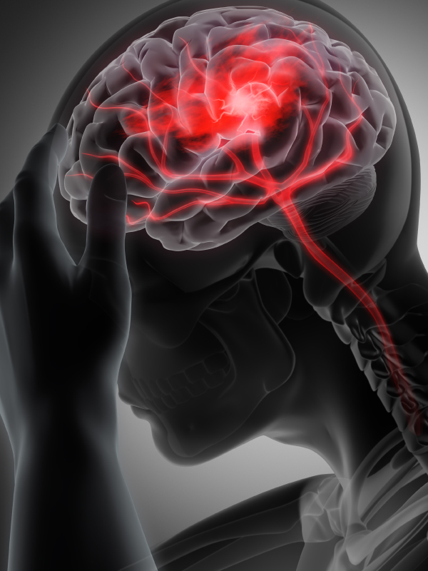 KOL Interview on Stroke