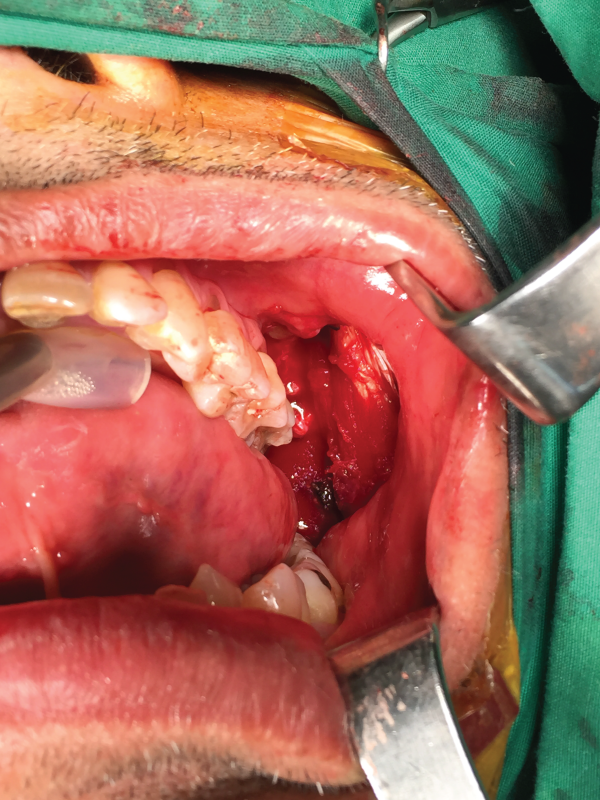 Oral Mucositis: An Urgent and Unmet Need of Cancer Patients