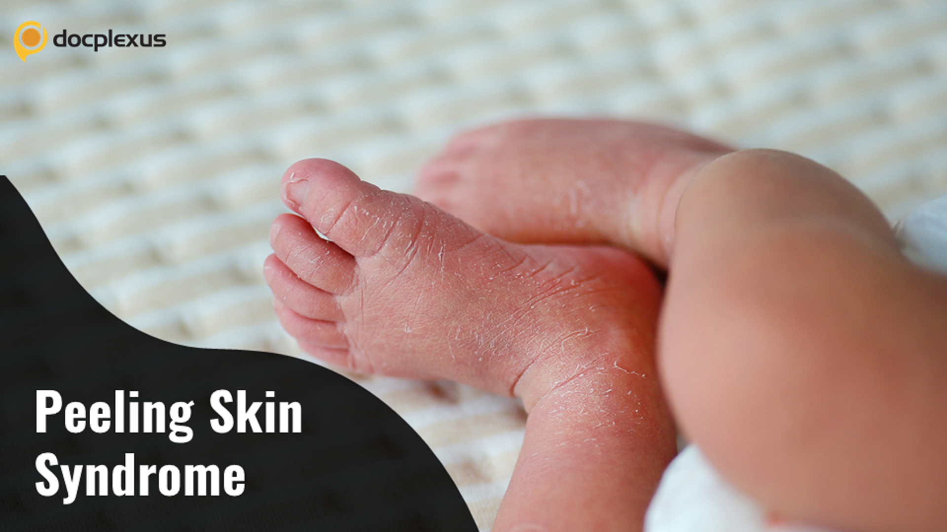 Peeling Skin Syndrome: A Rare Skin Disease