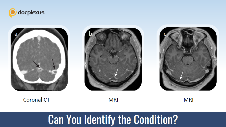 What Is the Underlying Cause of Confusion and Mild Responses in This Adolescent Girl?