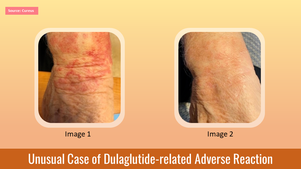 A Case of Dulaglutide-related Morbilliform Drug Eruption in a Geriatric Patient