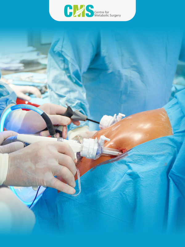 Role of Bariatric Surgery in Diabetes
