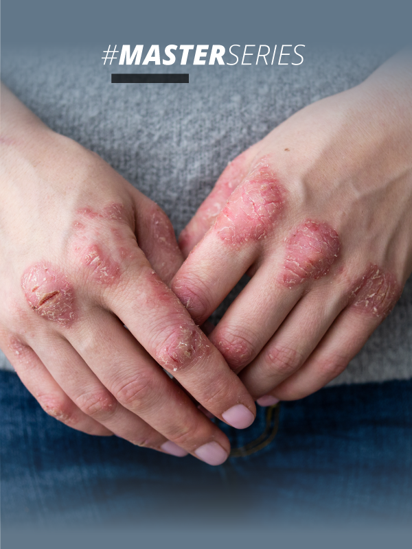 Fifty Shades of Psoriasis