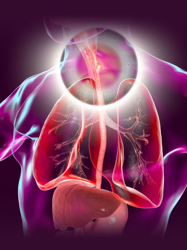 VATS Esophagectomy Complete Mediastinal Lymphadenectomy