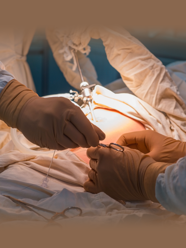 E-TEP Repair of Port Site Hernia