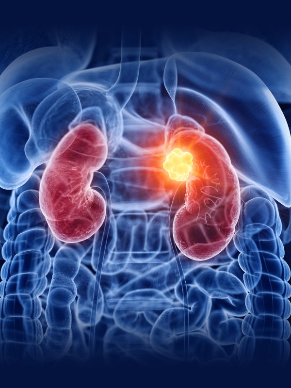 World Kidney Cancer Conference 2021