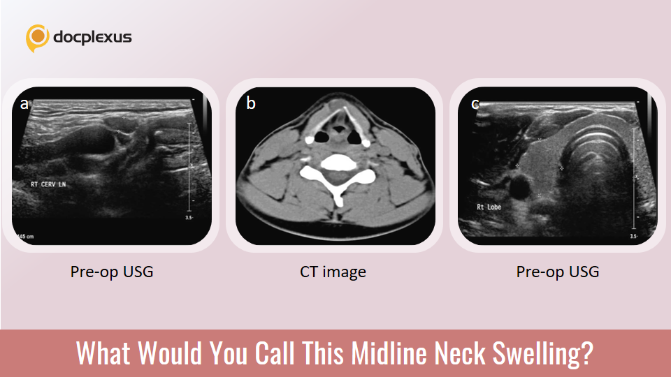 A 40-year-old Male with Tender Midline Neck Swelling