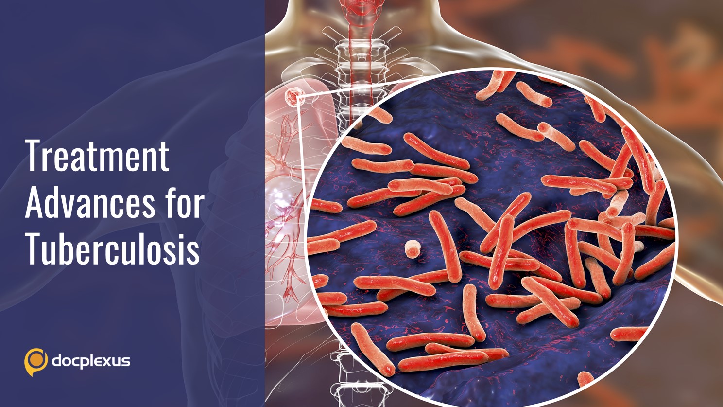 Progress and Advancements in the Treatment of Tuberculosis