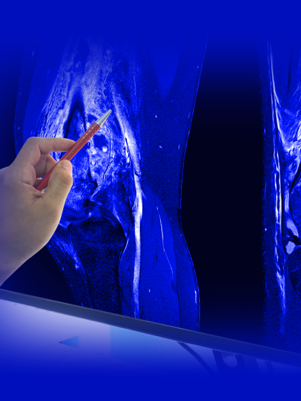Limb Salvage Surgery for Bone Tumors with Megaprosthesis