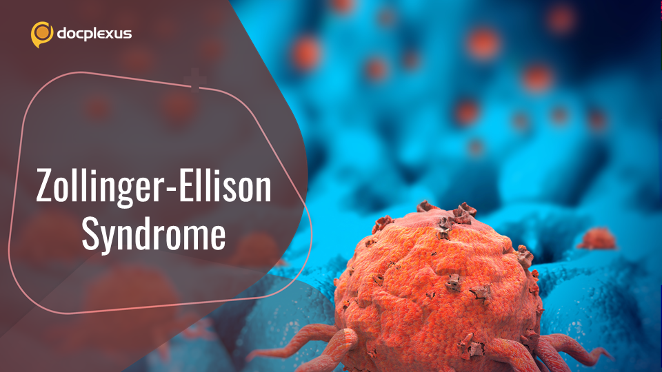 Zollinger-Ellison Syndrome (ZES): A Rare Disease