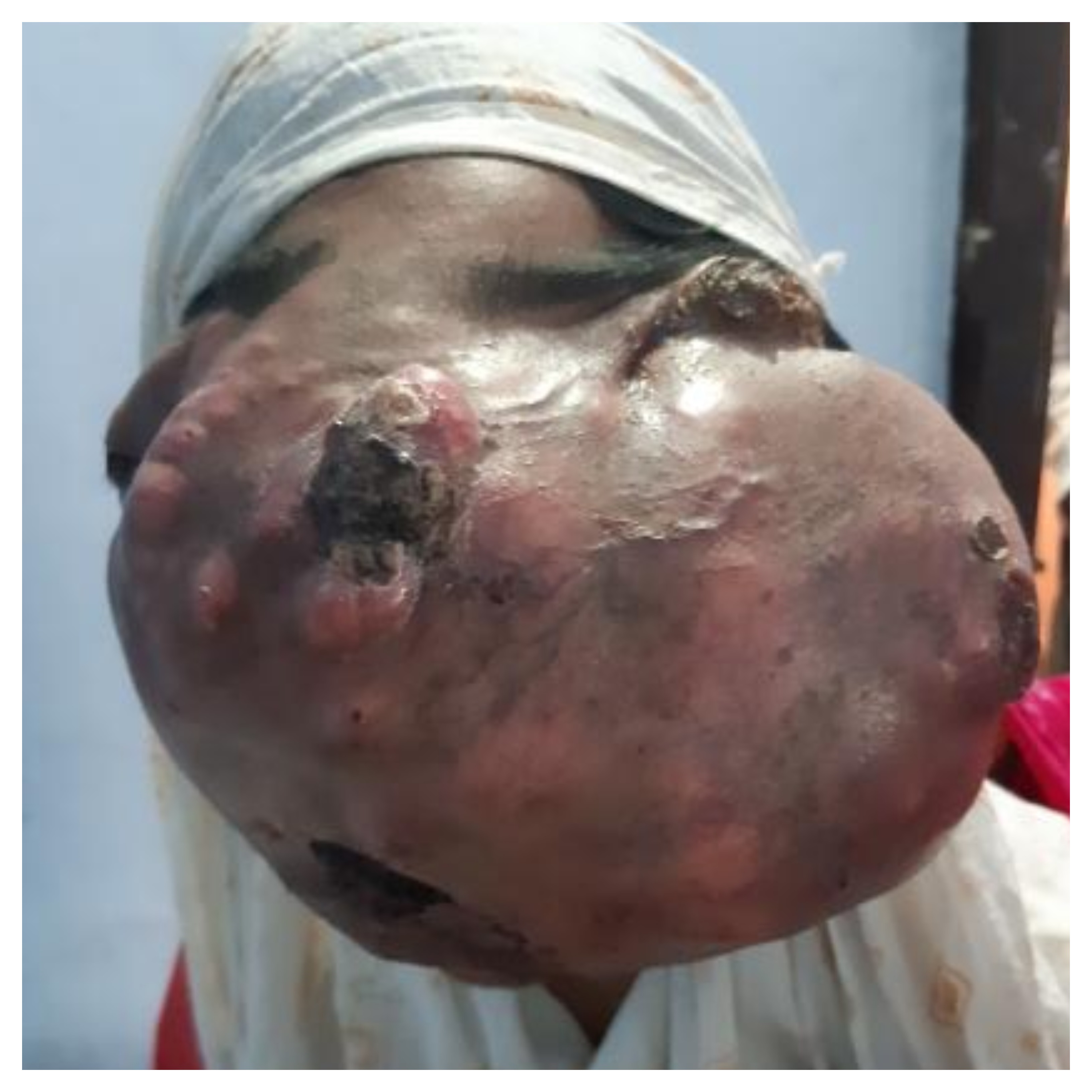 An Unusual Case of Osteosarcoma: What is Your Diagnosis?