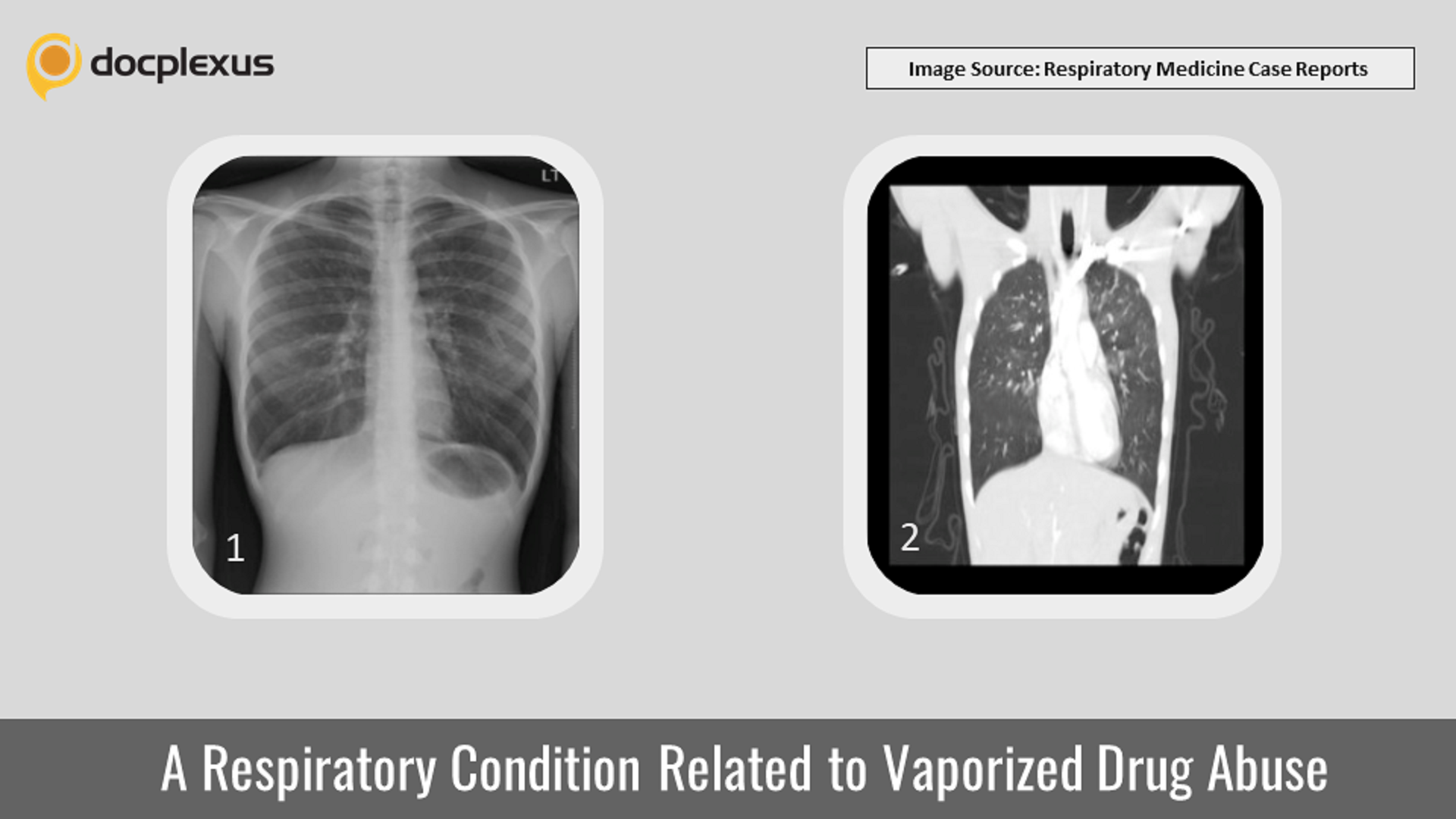 A Respiratory Condition Related to Vaporized Drug Use