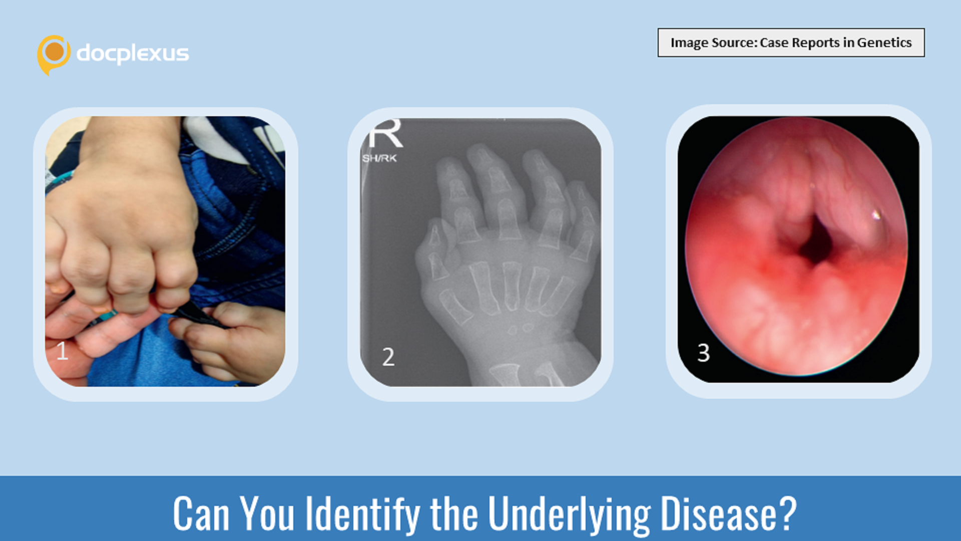 Identify the Cause of Arthralgia and Hoarseness of Voice in This Child