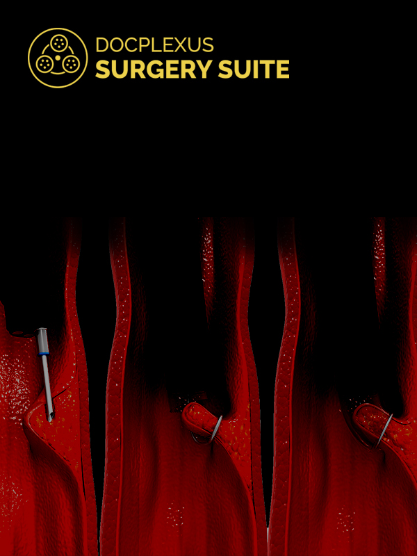 Endoscopic Dacryocystorhinostomy