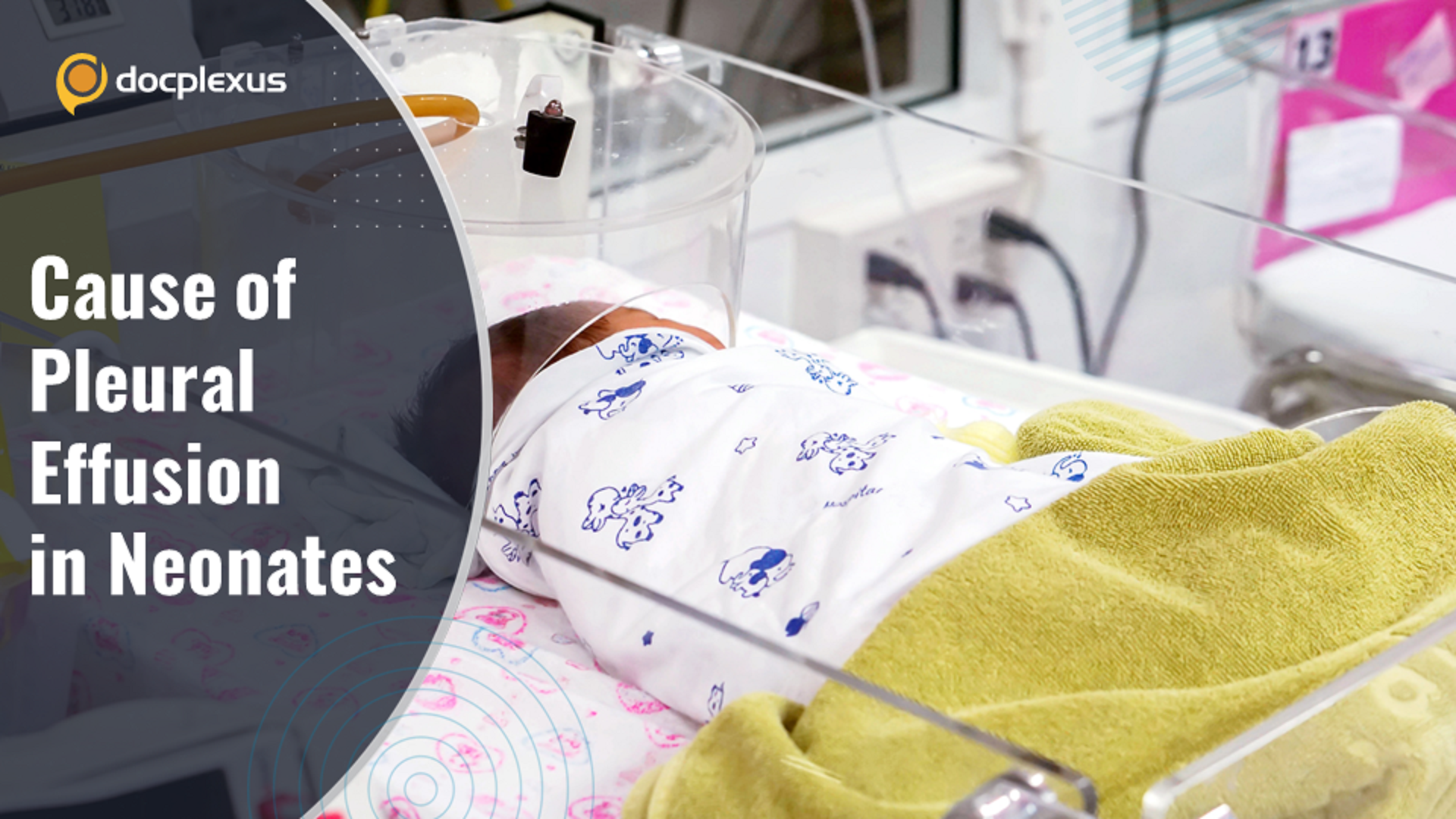 Congenital Chylothorax: Effusion in Neonates