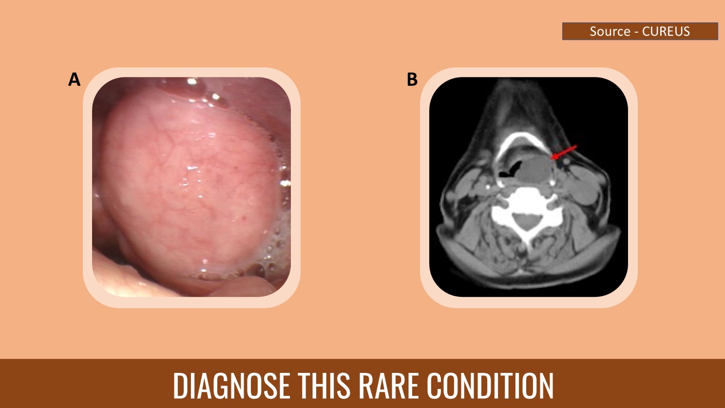 Diagnose This Rare Condition in an 81-year-old