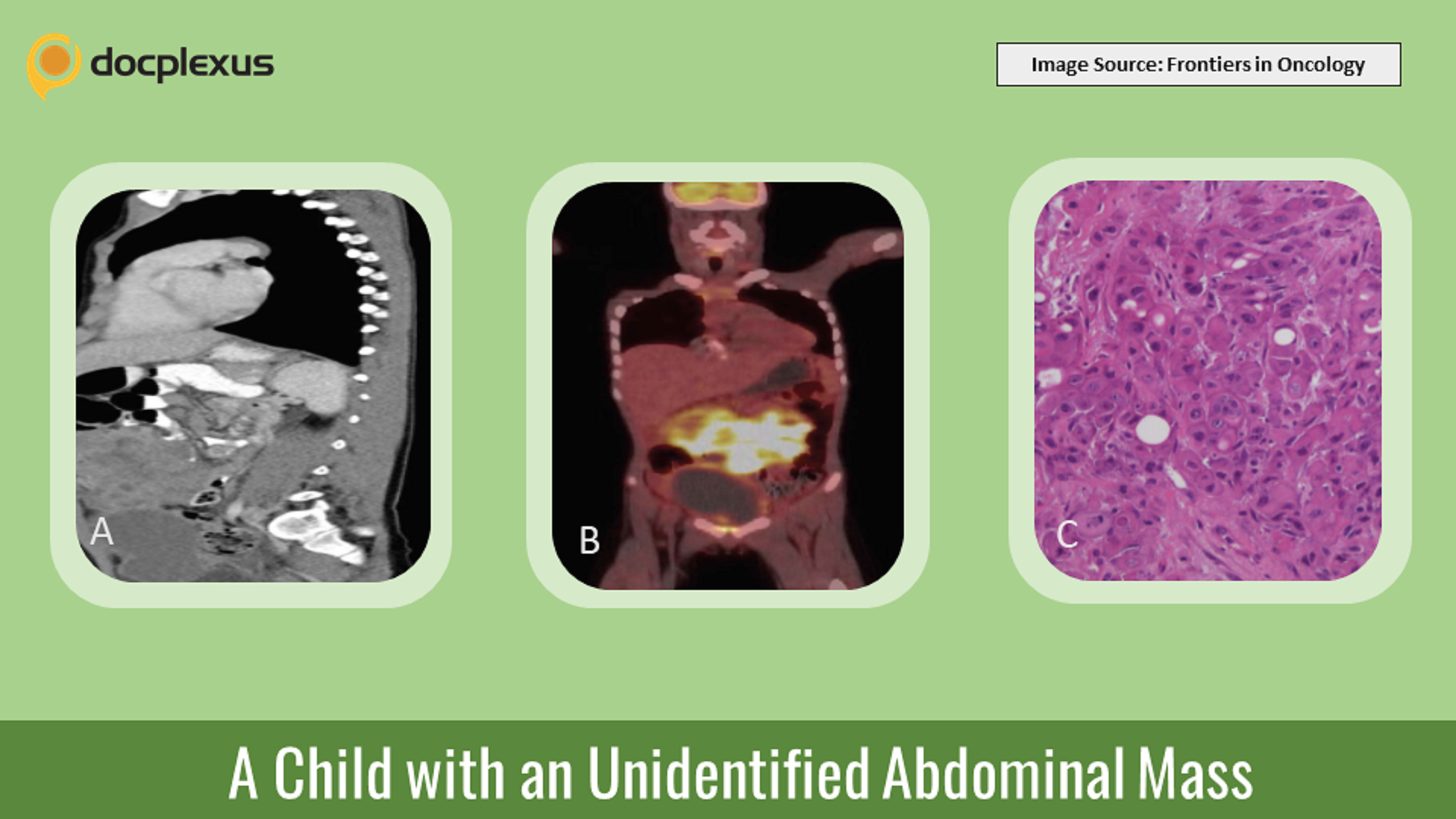 Can You Guess the Cause of This Unidentified Abdominal Mass?