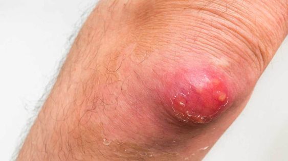What is this Disease?