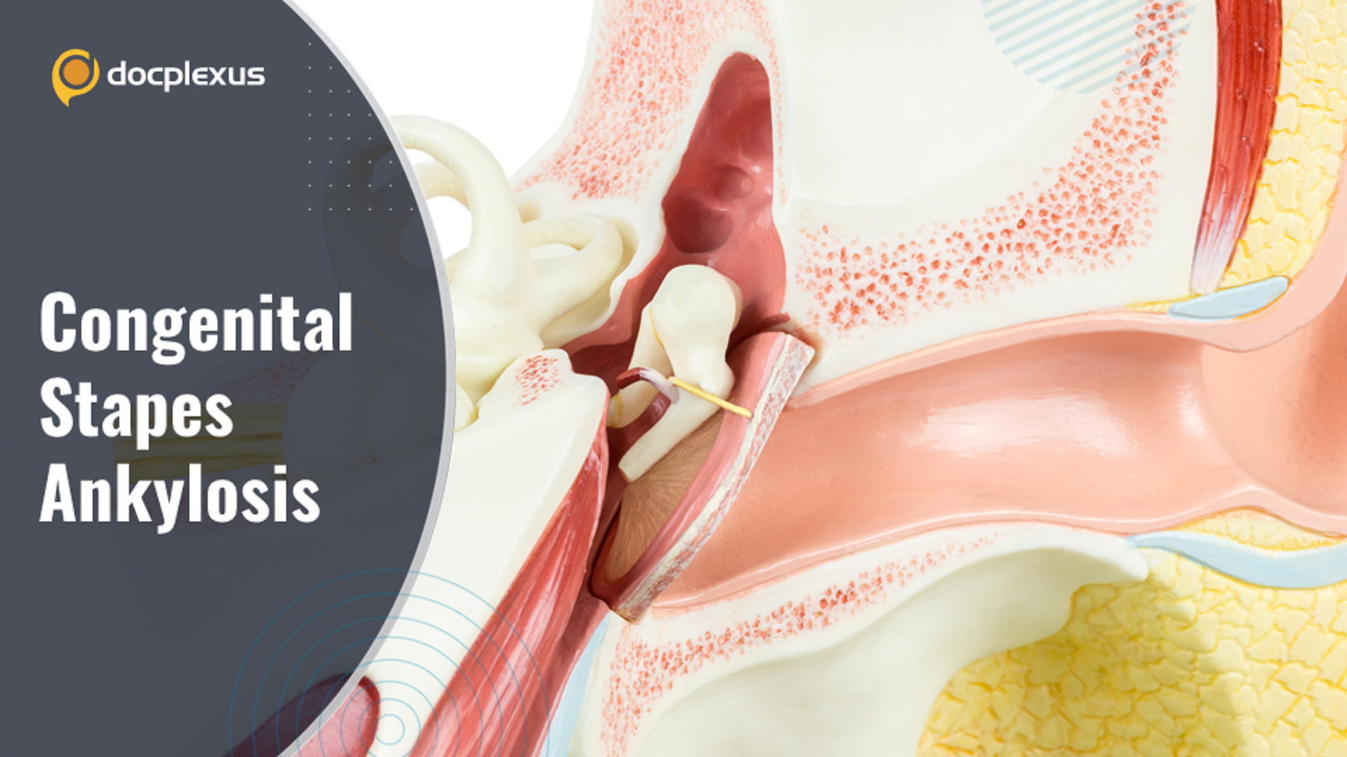 Congenital Stapes Ankylosis with Bony Synostosis Leading to Hearing Loss