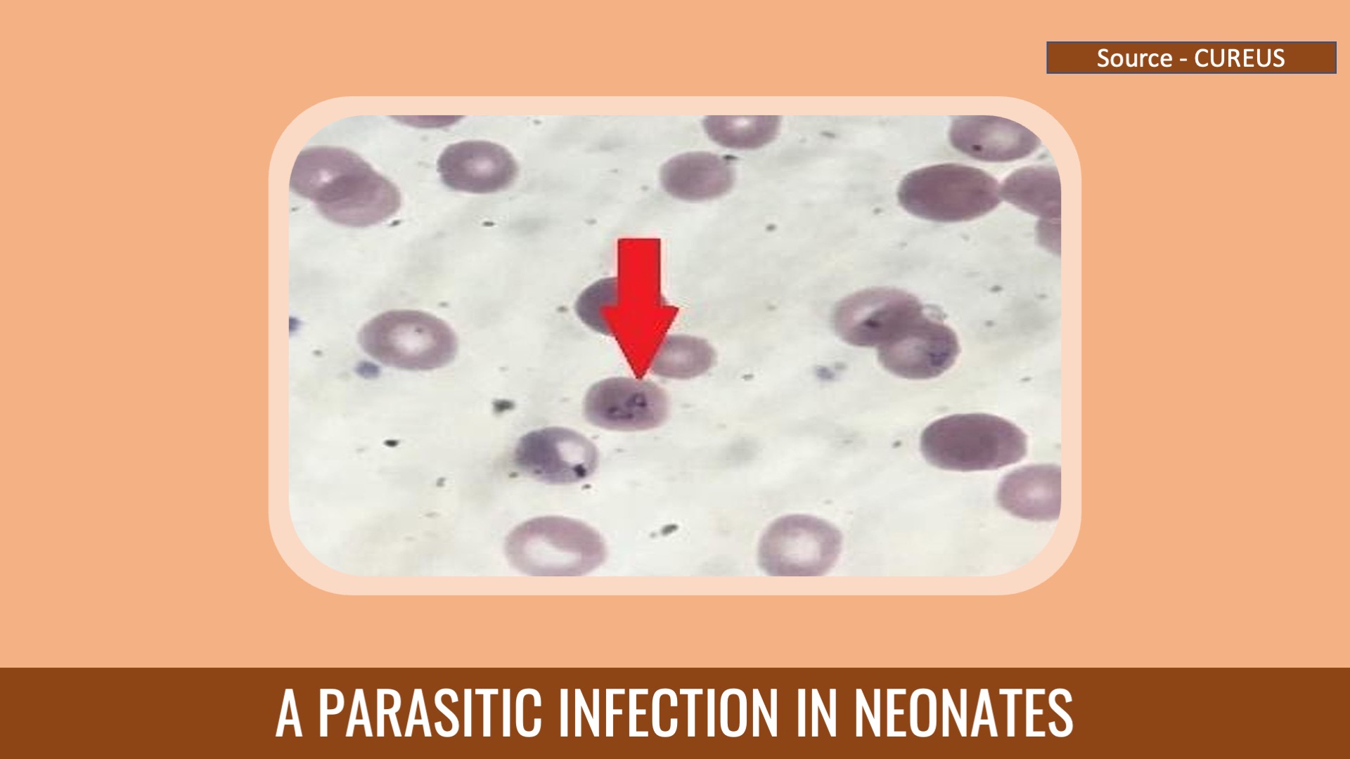 Asymmetric Congenital Babesiosis in a Neonate