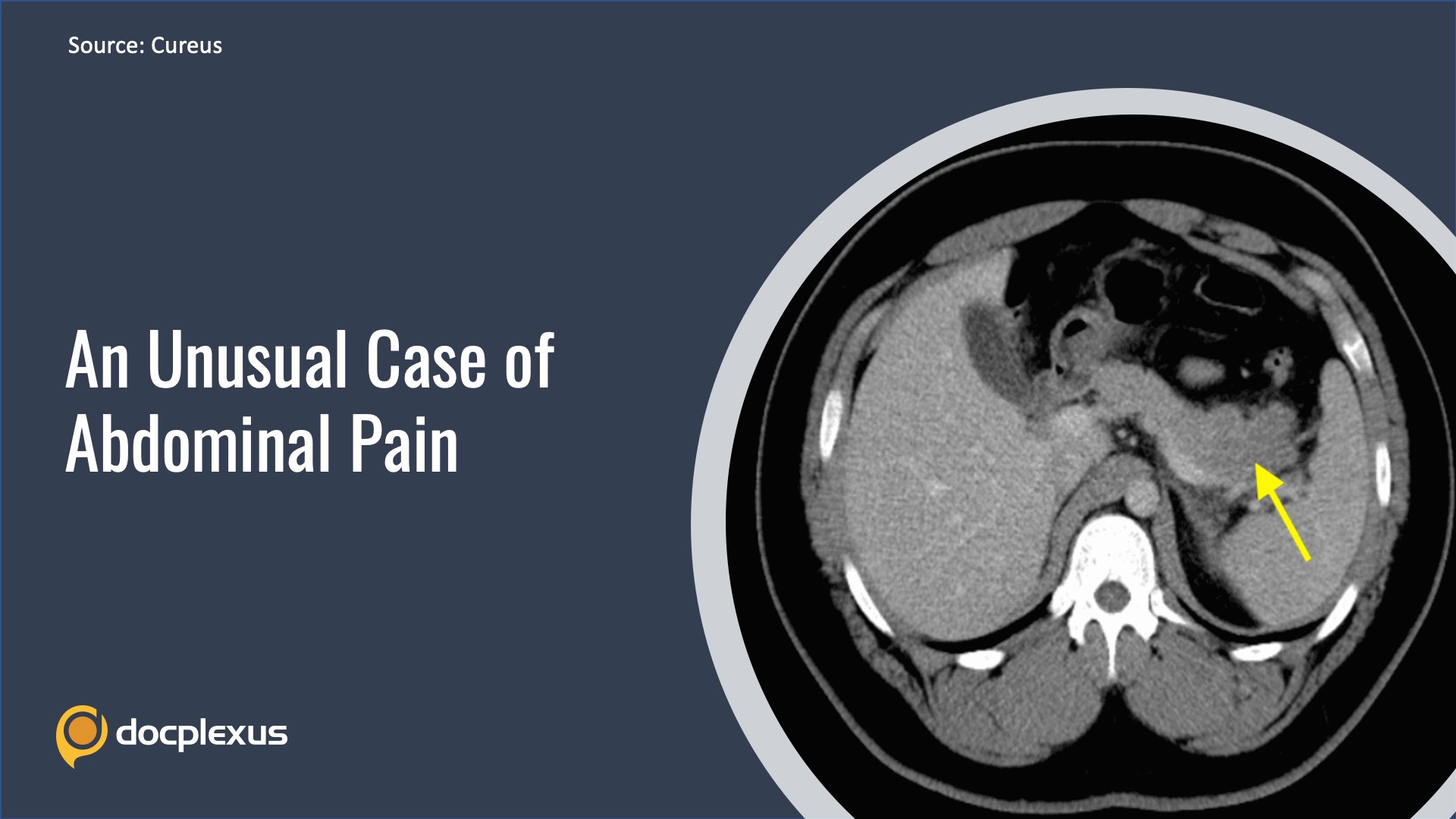 Identify the Cause of an Unusual Abdominal Pain