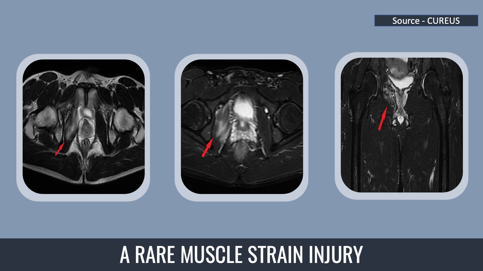 An Isolated Obturator Internus Muscle Strain Injury in a Football Player