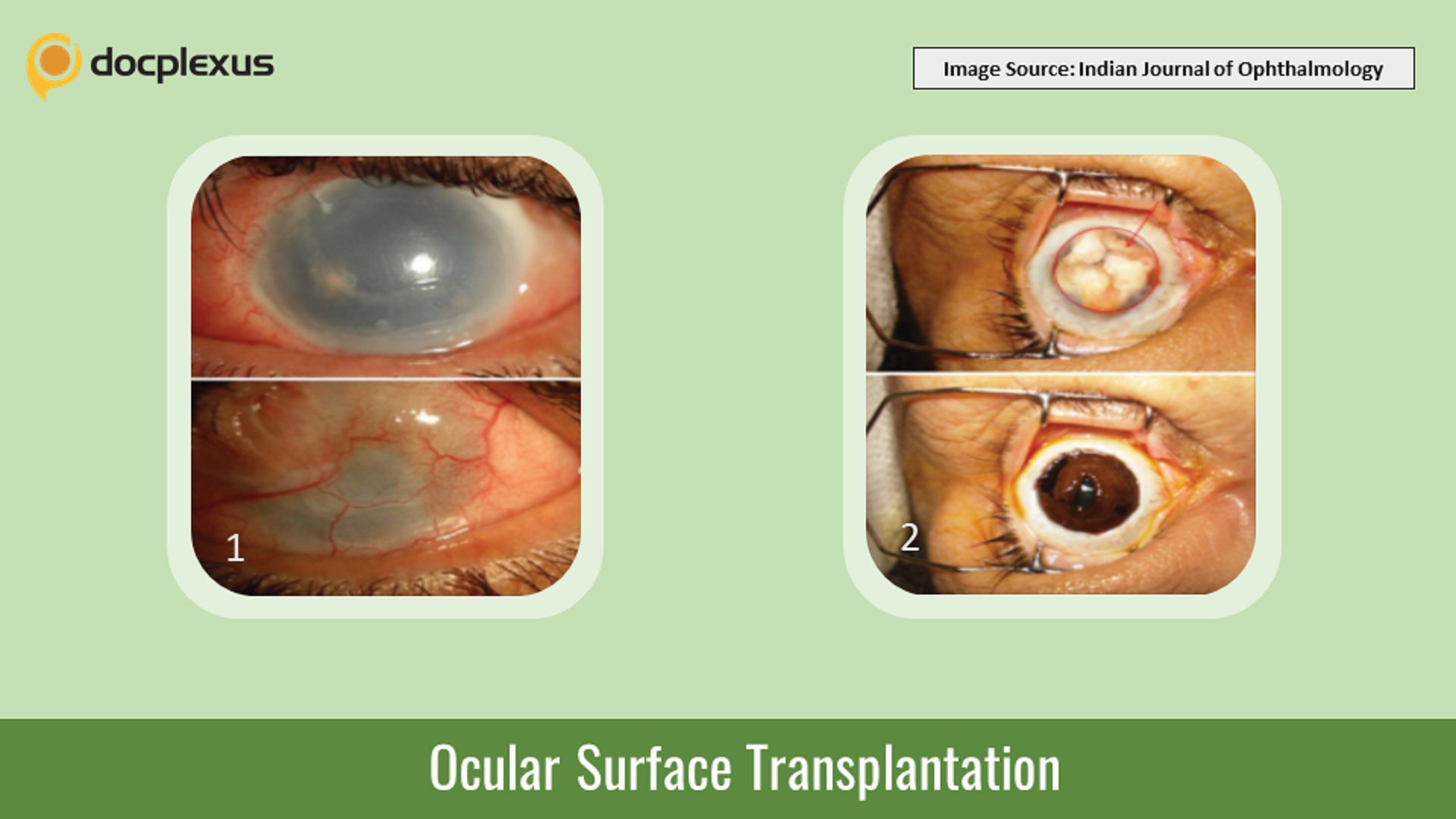 An Interesting Case of Full Ocular Surface Transplantation