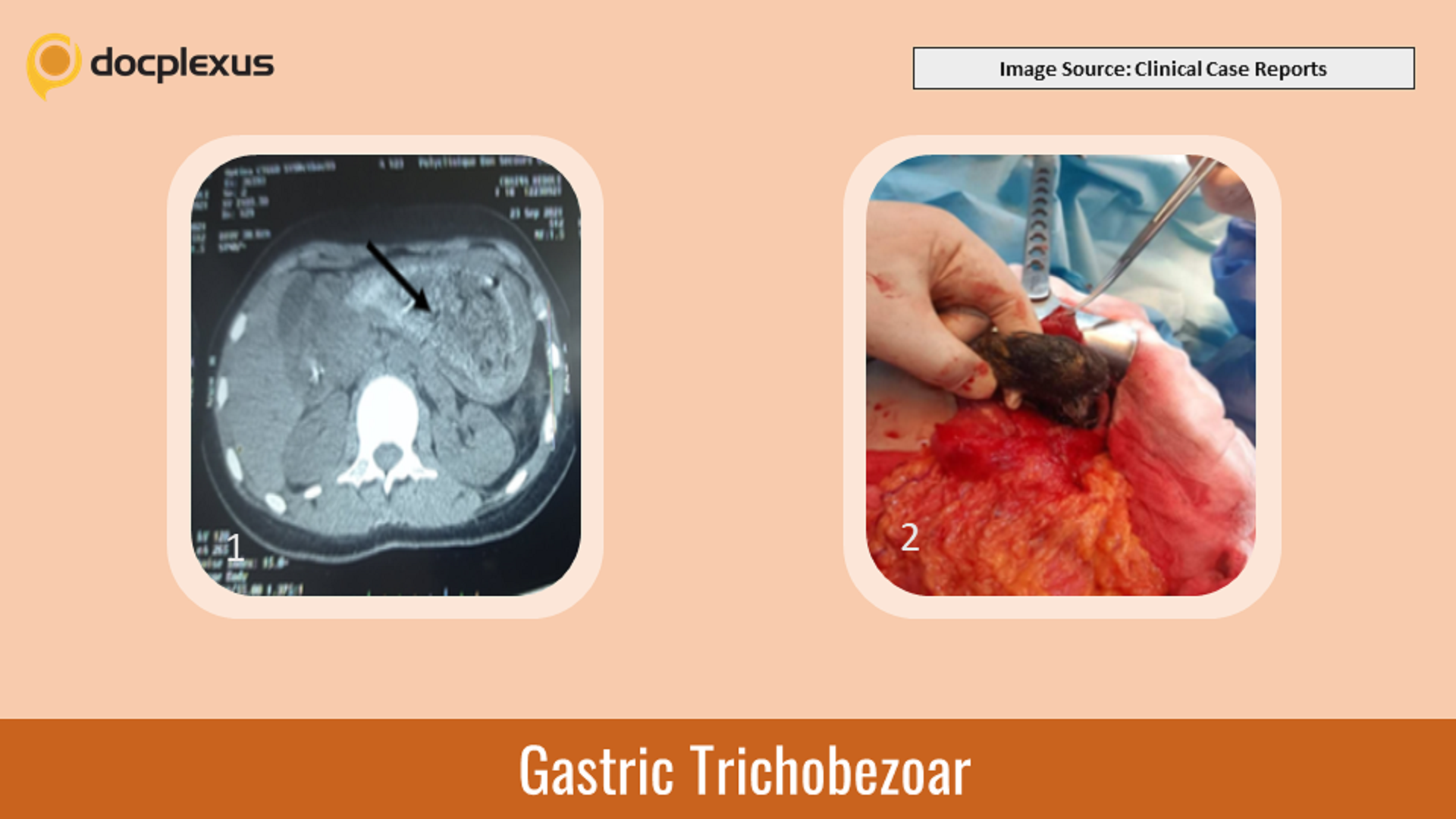 A Rare Cause of Epigastric Pain in a Young Female